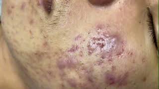 Blackheads amp Whiteheads Removal On Chin Boy 2024 Acne Treatment With Nhat Bang [upl. by Woothen]