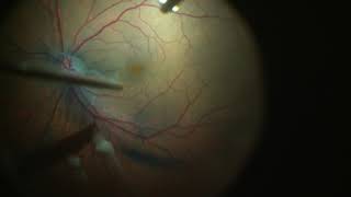 Fovea Sparing ILM Peeling for Vitreomacular Traction with Foveal Detachment [upl. by Stace]