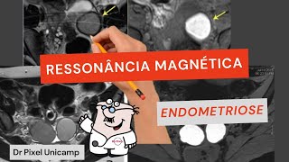 Ressonância magnética na endometriose [upl. by Westleigh]