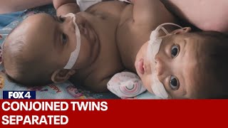 FULL VIDEO Conjoined twins separated at Cook Childrens Medical Center [upl. by Nelan]