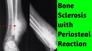 Bone sclerosis with periosteal reaction Differential Diagnosis [upl. by Augustina]