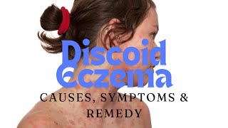 Understanding Discoid Eczema  Symptoms Causes and Remedyeczema awareness remedy [upl. by Mussman]