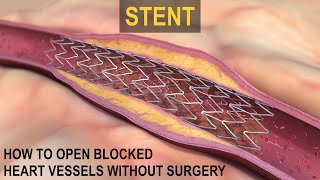 What is a STENT [upl. by Naraj]