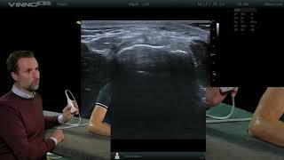 Elleboog  Common extensor tendon dwars  E14  echografie [upl. by Sension]