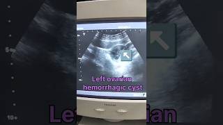 Left ovarian hemorrhagic cyst ultrasound showing video medical ultrasound shorts viralpregnant [upl. by Haiacim]