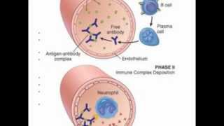 Systemic Lupus Erythrematosus SLE [upl. by Haberman]