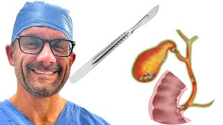 Treating Acute Cholecystitis with a Surgeon [upl. by Neemsaj]