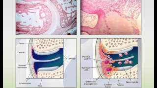 Rheumatoid Arthritis and Systemic Lupus Erythematosus Webinar [upl. by Secnirp]