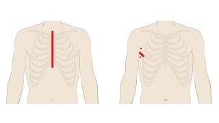 Mitral Valve Repair Different Surgery Approaches Sternotomy MiniSternotomy and Robotic [upl. by Mall]