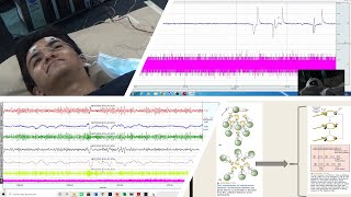 Electroencefalograma [upl. by Guglielmo117]