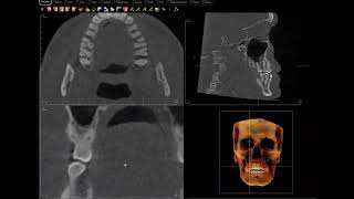 Cervicalexternal root resorption vs trigeminal neuralgia [upl. by Ydennek]