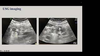 Intussusception ward rounds einass ravishankar 240916 [upl. by Edahc407]