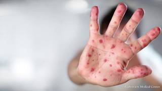 Washington state faces measles outbreak [upl. by Aratnahs237]