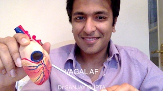 Vagal Atrial fibrillation [upl. by Shull]