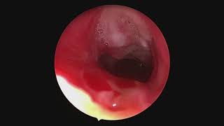 Subglottic stenosis  from injury to repair [upl. by Nylazor]