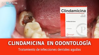 CLINDAMICINA PARA EL TRATAMIENTO DE INFECCIONES DENTALES AGUDAS [upl. by Eneladgam52]