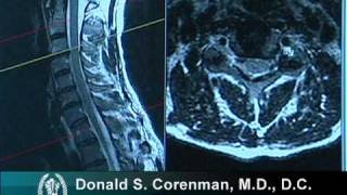 How to Read a MRI of Cervical Nerve Compression  Neck Pain  Colorado Spine Surgeon [upl. by Rowan]