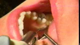 Septodont  Infiltration of the Permanent Mandibular First Molar [upl. by Grekin]