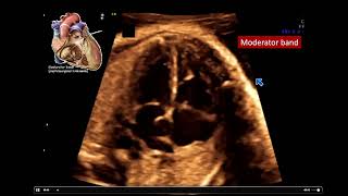 2022 Fetal Echocardiography Normal and Abnormal Hearts  A Video CME Teaching Activity [upl. by Haldis896]