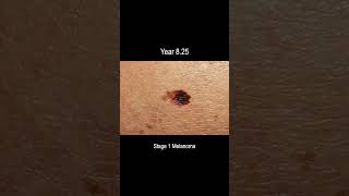 Melanoma Skin Cancer Development Time Lapse Normal to Stage 4 Melanoma Over 10 Years [upl. by Enywtna]