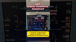 IABP Arterial Waveform Assessment cardiology criticalcare cathlab [upl. by Sidman]