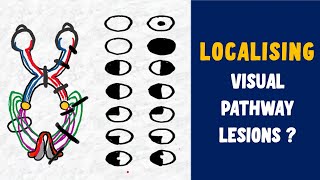 LESIONS OF VISUAL PATHWAY  SCOTOMAS EXPLAINED Junctional scotoma HOMONYMOUS HEMIANOPIA [upl. by Cleopatra]