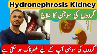 Hydronephrosis Kidney  Hydronephrosis Homeopathic Medicine  Kidney Swelling Treatment [upl. by Clive678]