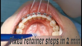 Fixed orthodontic retainer steps [upl. by Enetsirk529]