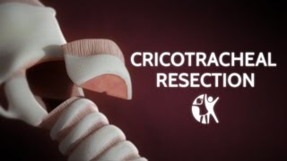 Cricotracheal Resection CTR  Airway Reconstruction  Cincinnati Childrens [upl. by Gavrilla675]