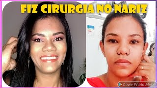 Alectomia Antes e depois1ª Cirurgia no nariz [upl. by Benedikta]