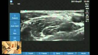 Ultrasound Guided Femoral and Lateral femoral cut nerve workshop [upl. by Pretrice]