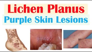 Lichen Planus “Purple Skin Lesions”  Causes Signs amp Symptoms Diagnosis Treatment [upl. by Eneri]