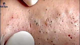 FULL SUPER BLACKHEADS 44 MINUTES [upl. by Livingston114]