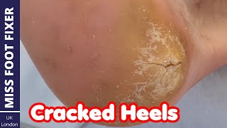 HOW TO TREAT DRY  CRACKED HEELS  CRACKED FOOT TREATMENT  BY MISS FOOT FIXER [upl. by Llenrahc]