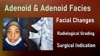 Adenoid । Adenoid Facies। Clinical Features। Clemens Grading।Adenoidectomy Indications [upl. by Meeharb214]