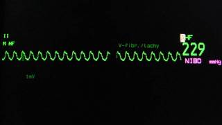 Ventricular tachycardia on an ECG monitor [upl. by Ayet]