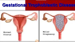 Gestational Trophoblastic Disease in Hindi [upl. by Nishi]