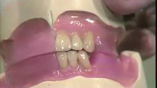 Setting Mandibular Anterior Teeth [upl. by Langill170]