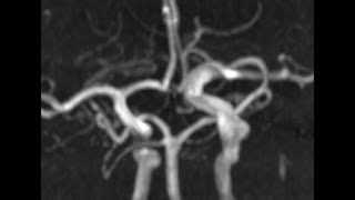 LIVE  flow diverter  fusiform aneurysm ICA [upl. by Orteip]