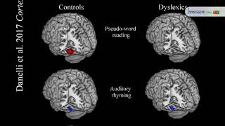 Dislessia dalle neuroscienze nuovi studi per la diagnosi e la riabilitazione [upl. by Tailor]