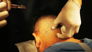 DermoJet for hair transplantation needleless local anesthetic administration AbsoluteHairClinic [upl. by Pacifa628]