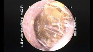 Ear wax removal Dry fungal cleaning 🧹 20241014 [upl. by Benildas533]