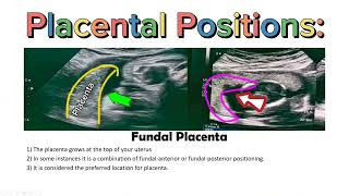 Placenta Positions on Ultrasound  AnteriorPosteriorFundalLateral Placental Positioning USG [upl. by Ainoda]