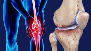 Tricompartmental Osteoarthritis Causes And Treatment [upl. by Evelunn5]