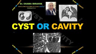 Cyst or Cavity [upl. by Ellynad]