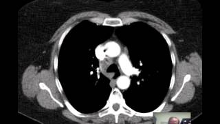 CT Chest Lung Nodule Discussed by Radiologist [upl. by Shellans]