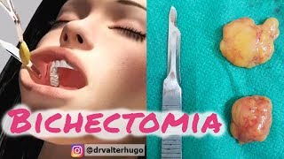 BICHECTOMIA Antes e Depois  Valor Como é a Cirurgia [upl. by Bucella85]