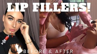 1ML LIP FILLER EXPERIENCE  FIRST TIME GETTING LIP INJECTIONS VLOG  BEFORE amp AFTER  Leah Monroe [upl. by Maurer176]