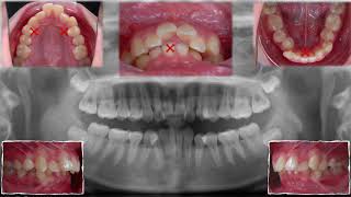 Chris Top 11 Cases 4 Class II Excessive Overjet and Deep Bite｜【Chris Chang Ortho】CC456 [upl. by Nyrmac]