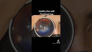 Healthy Fundus retina Healthy disc Normalfundus eye myopia [upl. by Ttenyl]